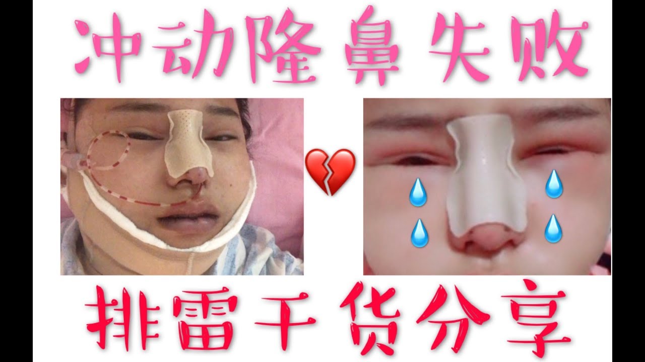 从小被说丑八怪 自卑隆鼻又失败 经历分享 还不做功课 别学我没做好功课被坑做3次鼻子 干货分享 Youtube