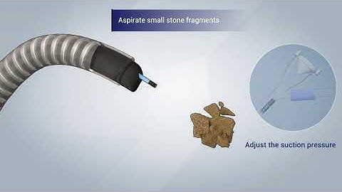 Microport Urocare Vacuum assisted Bendable Ureteral Access Sheath