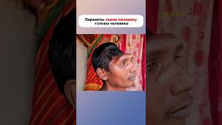 Паразиты съели половину головы #история #факты #новости #интересно