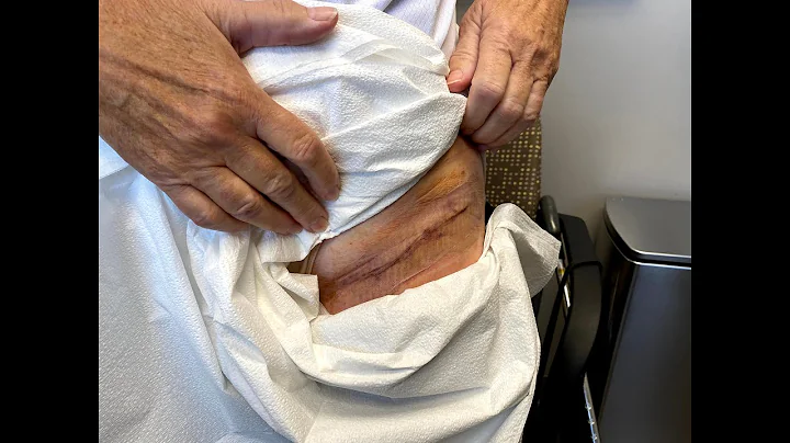 1 Week Follow Up Cosmetic Hip Replacement Doing Gr...
