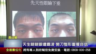 台北榮總蘇澳暨員山分院1060513天生瞇瞇眼遭霸凌 開刀整形重獲自信