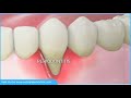 Stages Of Gum Disease | Best Gum Diseases Treatment in Bellandur | Nelivigi Dental Clinic