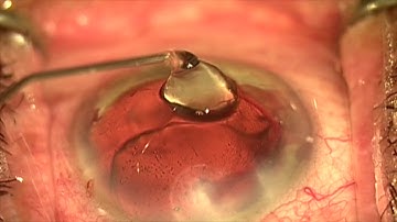 iStent inject placement by Steven G. Safran MD