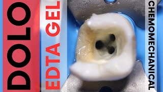 Dolo EDTA Gel 🟢 Chemomechanical Preparation of Mandibular Molar 🟡 Prevest Denpro screenshot 1