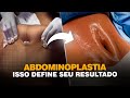 Os 5 Passos Que Definem o Sucesso da Abdominoplastia em 2026 | Dr. Ícaro Samuel