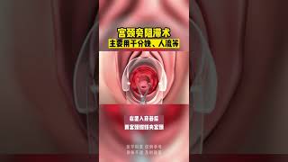 带你了解，宫颈旁阻滞术 #医学科普 #关爱女性健康 #宫颈