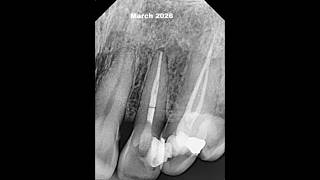 Non surgical Management of large Periapical lesion. #bioceramics #rootcanal #endo #rct