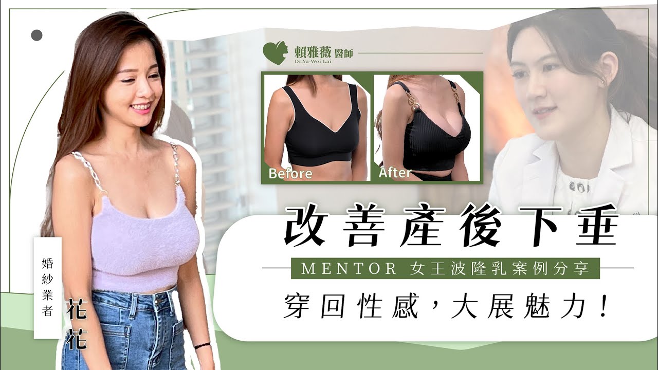 【頤森隆乳案例｜花花】改善產後下垂，穿回性感，大展魅力！Mentor女王波隆乳—整外女醫 賴雅薇 醫師