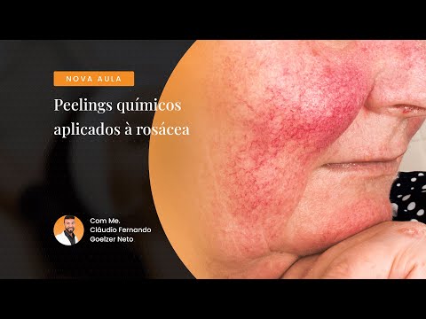 Vídeo: Você Pode Fazer Peeling Facial Para Rosácea?