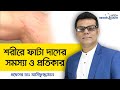 শরীরের ফাটা দাগ দূর করার উপায় - শরীরের দাগ দূর করার উপায় - ফাটা দাগ দূর করার উপায়