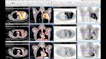 FusionSync Prototype: PET-CT Follow-up Examination