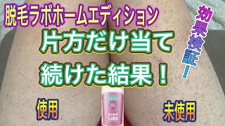 【脱毛ラボホームエディション】効果検証。半分だけやったら違い