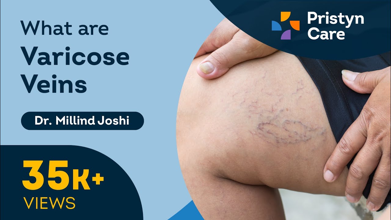 Laser Treatment for Varicose Veins | Varicose Veins Surgery