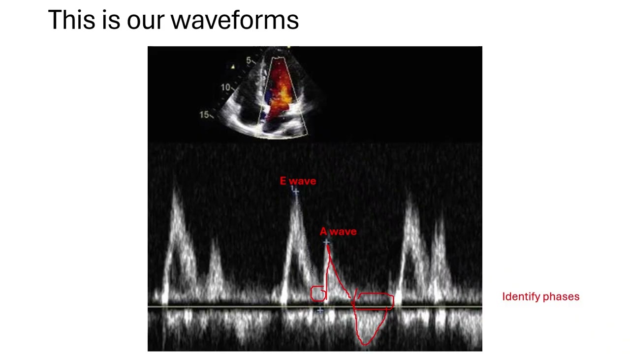 Diastology Basics - Diastolic Dysfunction on ECHO
