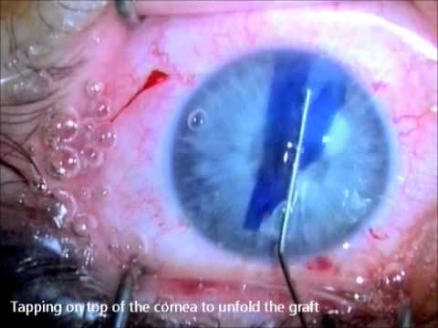 DMEK: standard "no-touch" technique - NIIOS Rotterdam