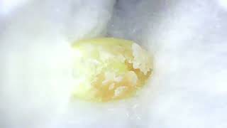 Grandmas Mimikaki Earwax Cleaning Impacted Cerumen