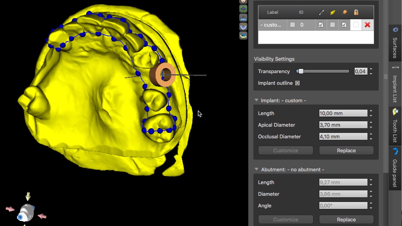 Blue sky Plan "Change your implant position without redrawing your