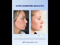 The Golden Ratio Profile: Seamless Full-Face Harmony 📐✨