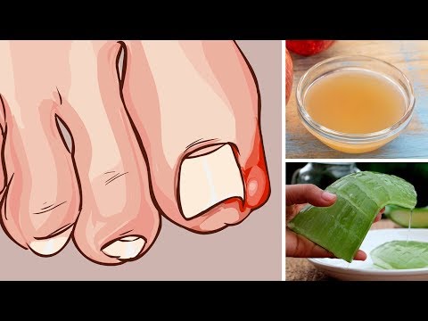 Video: Ingrown Toenail: Ano Ang Gagawin Sa Bahay, Mga Pagsusuri