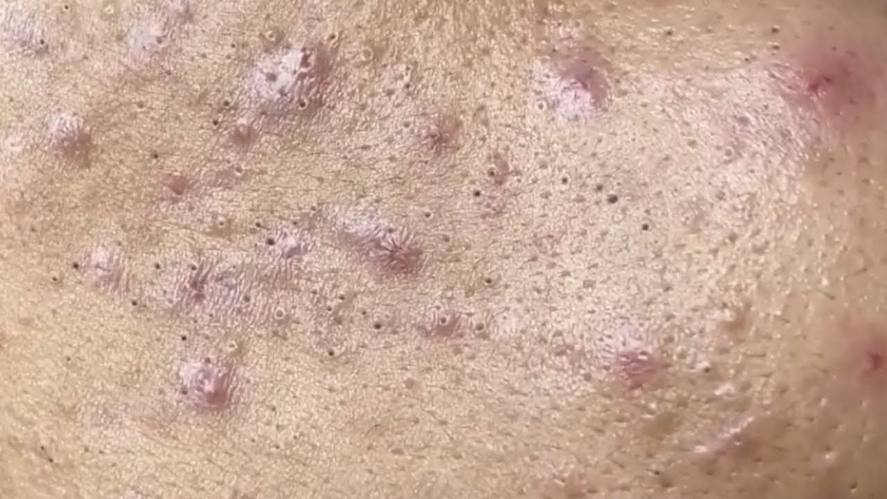 Popping Blackheads And Pimple Popping Best Pimple Popping Videos 18