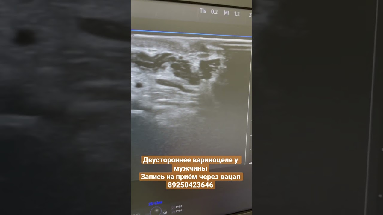 Не забудьте поставить лайк 👍 Двустороннее варикоцеле у мужчины ...