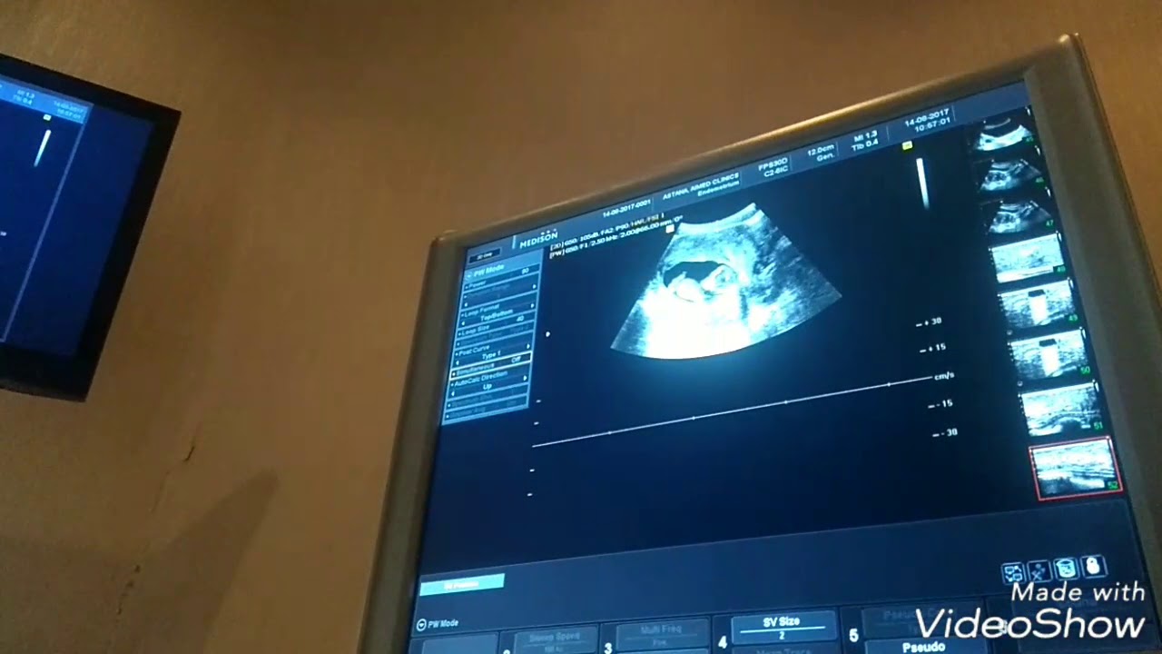 Скрининг 12 недель беременности Мальчик - YouTube