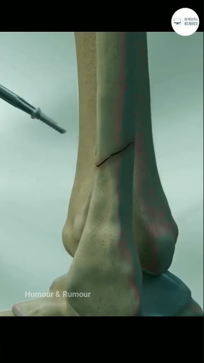 Fractured Bone Intramedullary Rod Operation|| Understanding With 3D model|| Tooti Huwi Hadi Hindi||