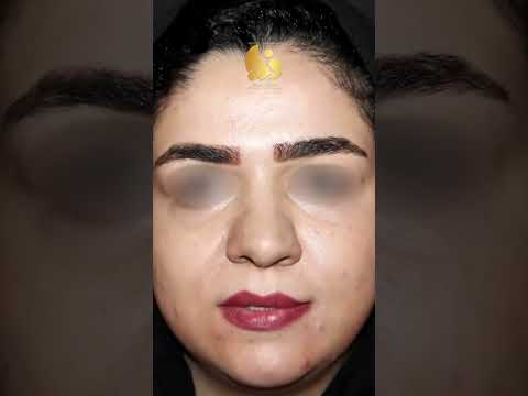 نمونه ای دیگر از جراحی زیبایی بینی دکتر مسعود ناصری صدر