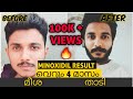 How to grow beard and mustache faster in malayalam minoxidil result