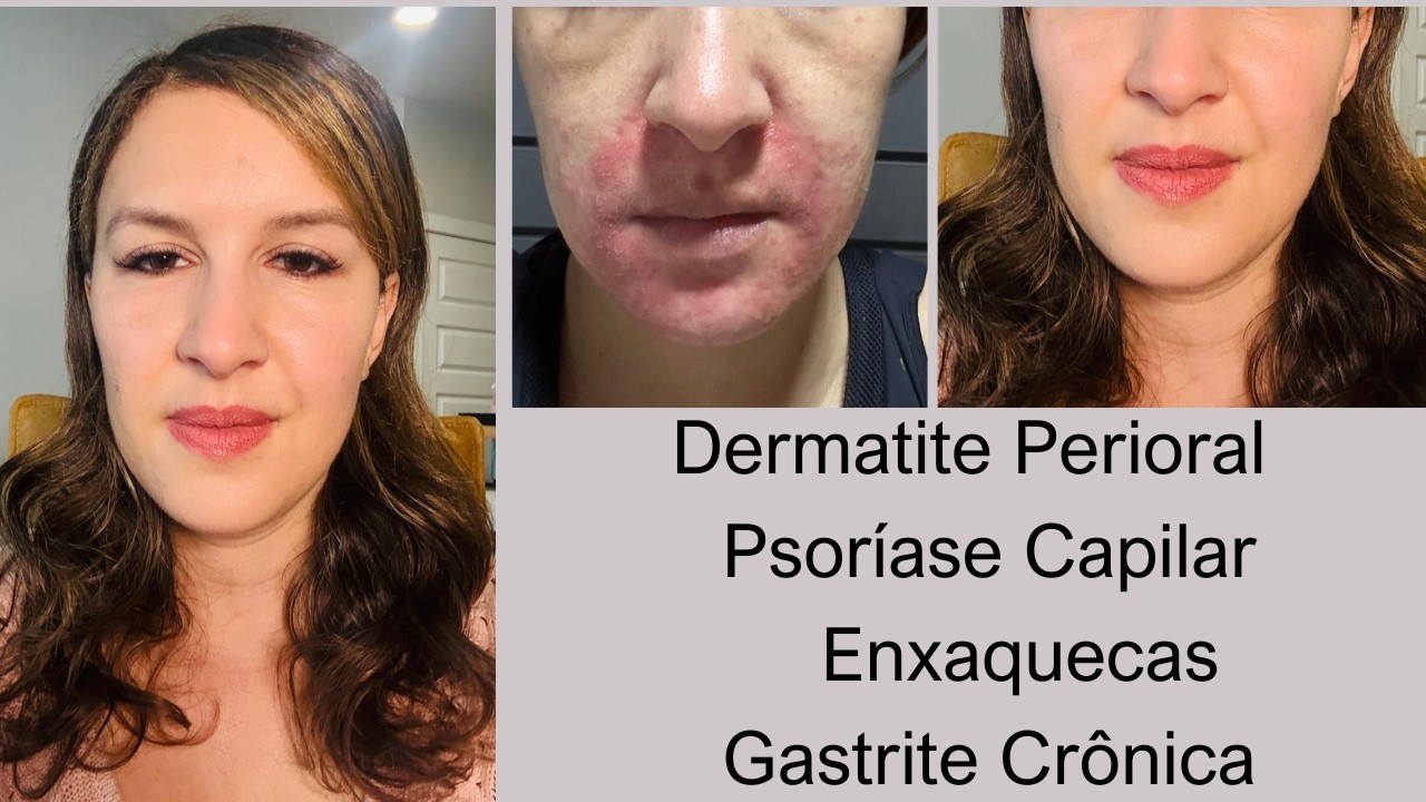 Gisele - Dermatite Perioral, Psoríase Capilar, Enxaquecas e Gastrite Crônica #1120