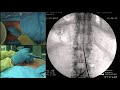 Live Demonstration – Lumbar Spinal Cord Stimulation Trial Brett Stacey, M.D.