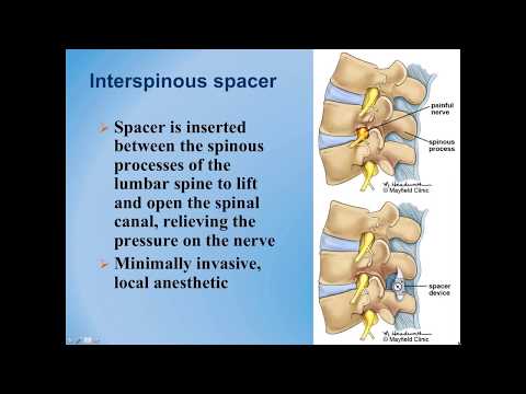 Lumbal spinal stenose: diagnose og behandlingsmuligheder