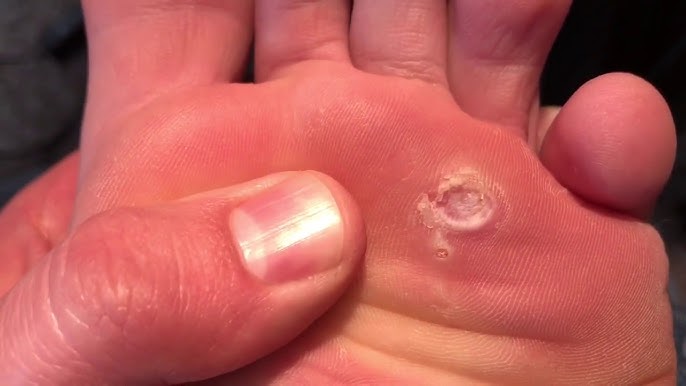 DAY 60: Plantar Wart Removal Using Compound W Update! 