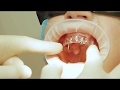 Хирургический шаблон для имплантации зубов - быстрая и точная установка имплантов