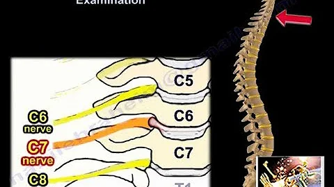 Cervical Spine Nerve Root Examination - Everything You Need To Know - Dr. Nabil Ebraheim