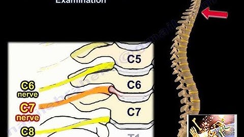 Cervical Spine Nerve Root Examination - Everything You Need To Know - Dr. Nabil Ebraheim