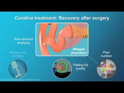 Video: Pancreatic Cancer - Signs And Symptoms, Stages And Degrees, Pancreatic Cancer Treatment