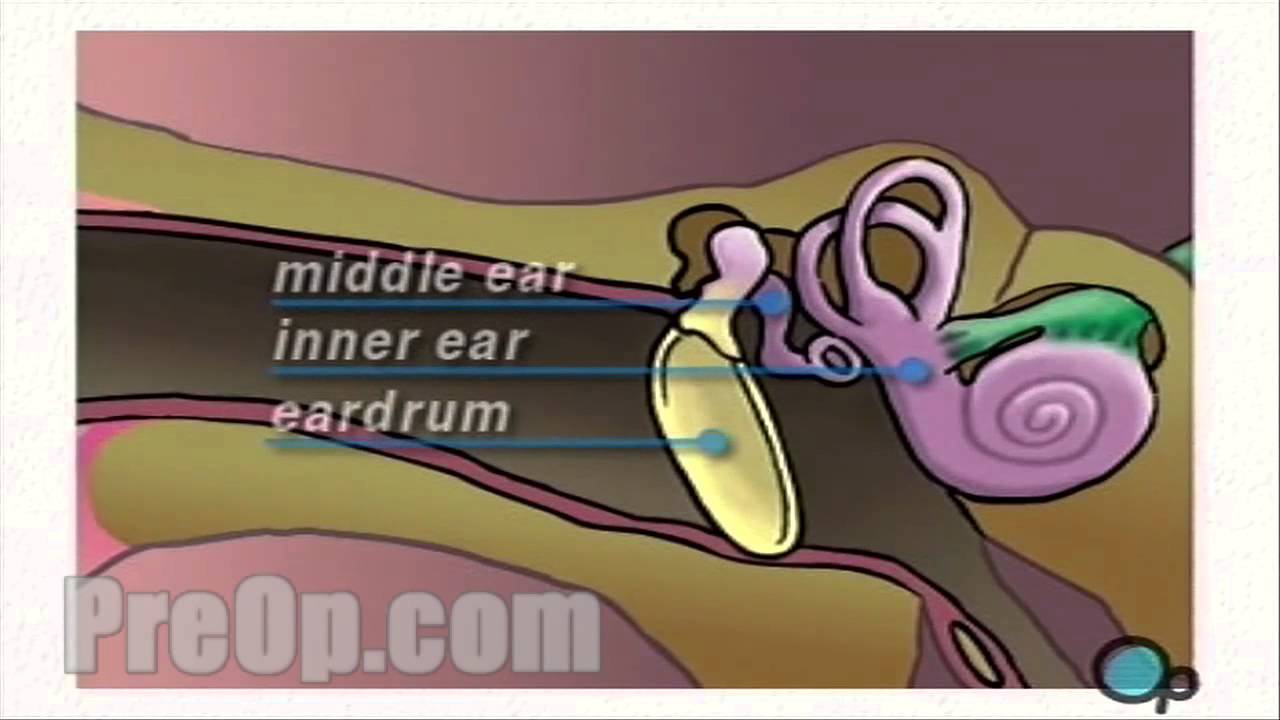 Myringotomy Insertion of Tube Surgery PreOp® Patient Engagement and Education YouTube