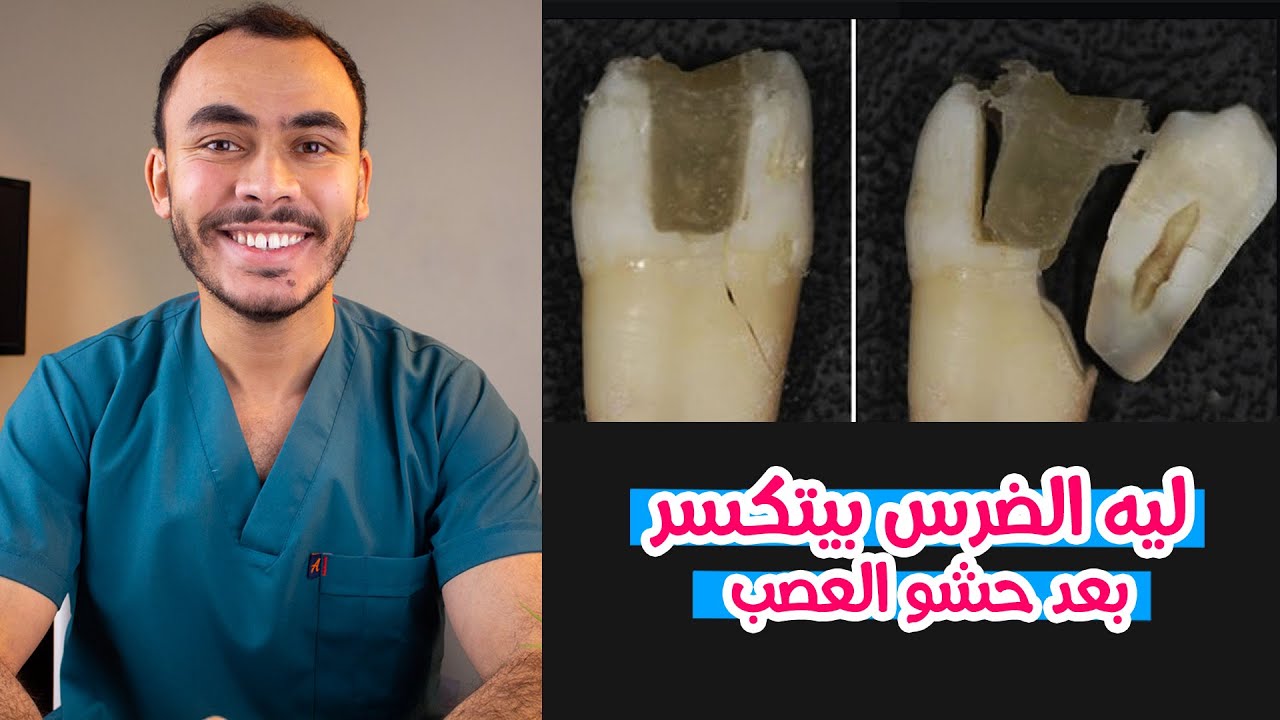 ليه الضرس بيتكسر بعد حشو العصب ؟ و هل لازم طربوش للضرس بعد حشو العصب ؟