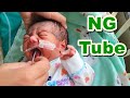 Nasogastric (NG) Tube Insertion in Neonate / Newborn | Orogastric Tube / Feeding Tube