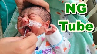 Nasogastric Ng Tube Insertion In Neonatenewborn Orogastric Og Tubefeeding Tube Paediatric