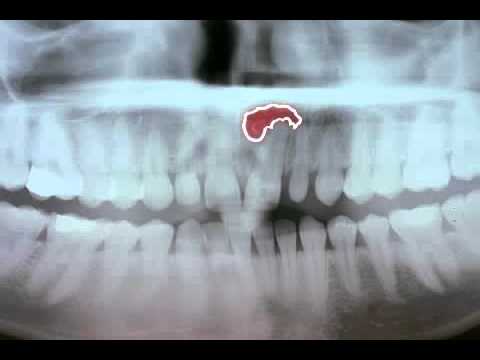 Video: Bump On Gums: 7 Cauze Ale Denivelărilor Dureroase, Nedureroase, Dure Sau Moi