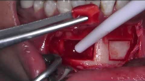 Harvesting Autogenous Bone