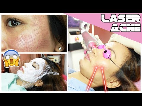 LASER TREATMENT for ACNE SCARS, WARTS & SYRINGOMA | RealAsianBeauty