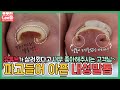 (ENG SUB)유튜브가 살려줬다며 너무 좋아하시던 고객님~ 이제 파고든 내성발톱이랑 헤어져요 ingrown toenail / ingrowing nail - Fresh Foot