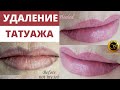 Перекрытие татуажа губ. Лазерное удаление татуажа губ #Shorts