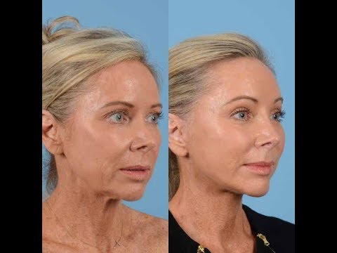 Undetected Facelift Incisions