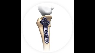 CCWO  Cranial Closing Wedge Osteotomy (CWO, CTWO) Surgical Technique / Technika operacyjna TPLO CWO