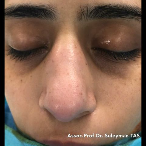 Wide Nose | Closed Atraumatic Rhinoplasty