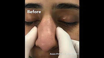 Wide Nose | Closed Atraumatic Rhinoplasty